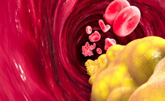 Is LDL Cholesterol Driving CVD? Are Statins the Solution?